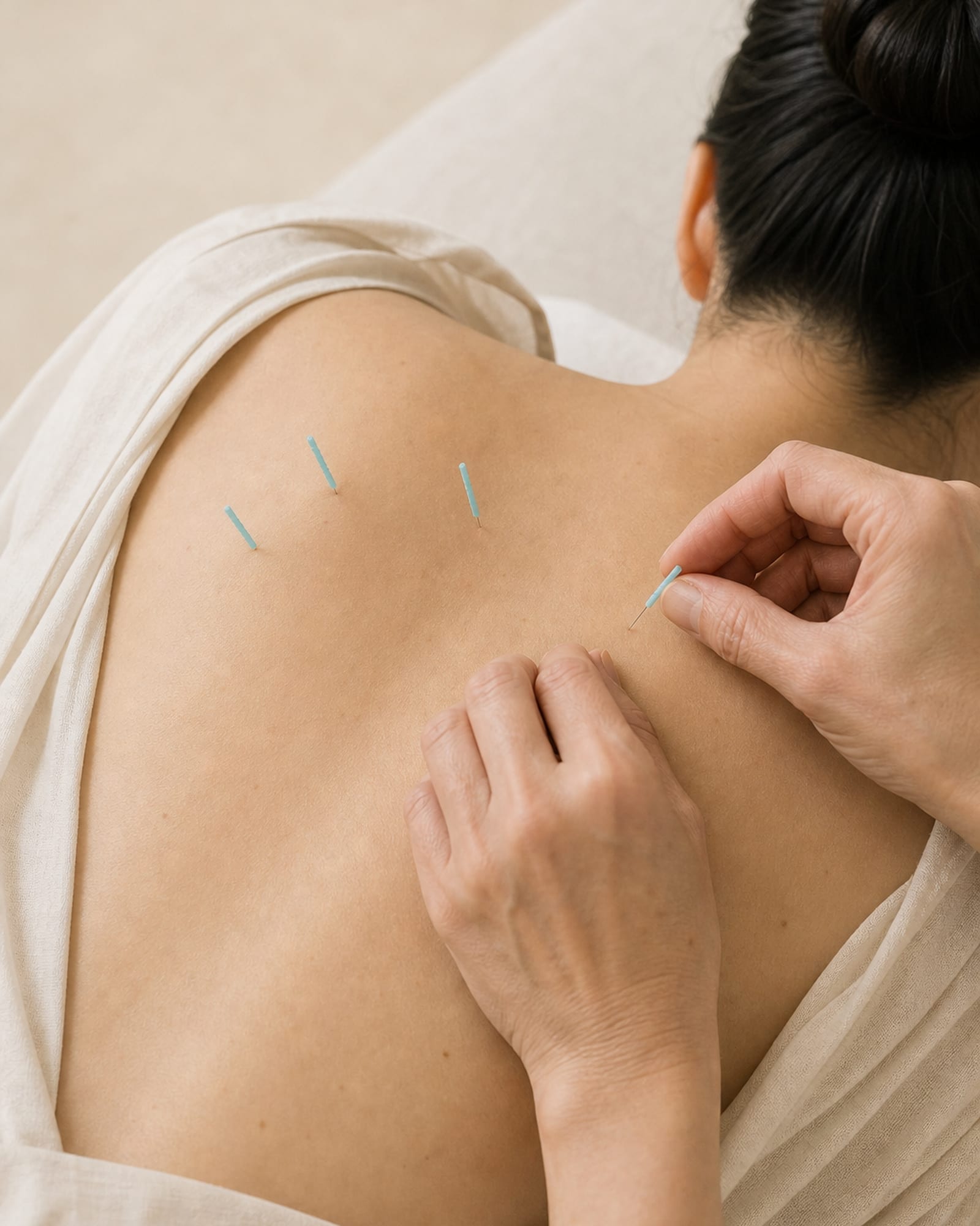 Body Acupuncture